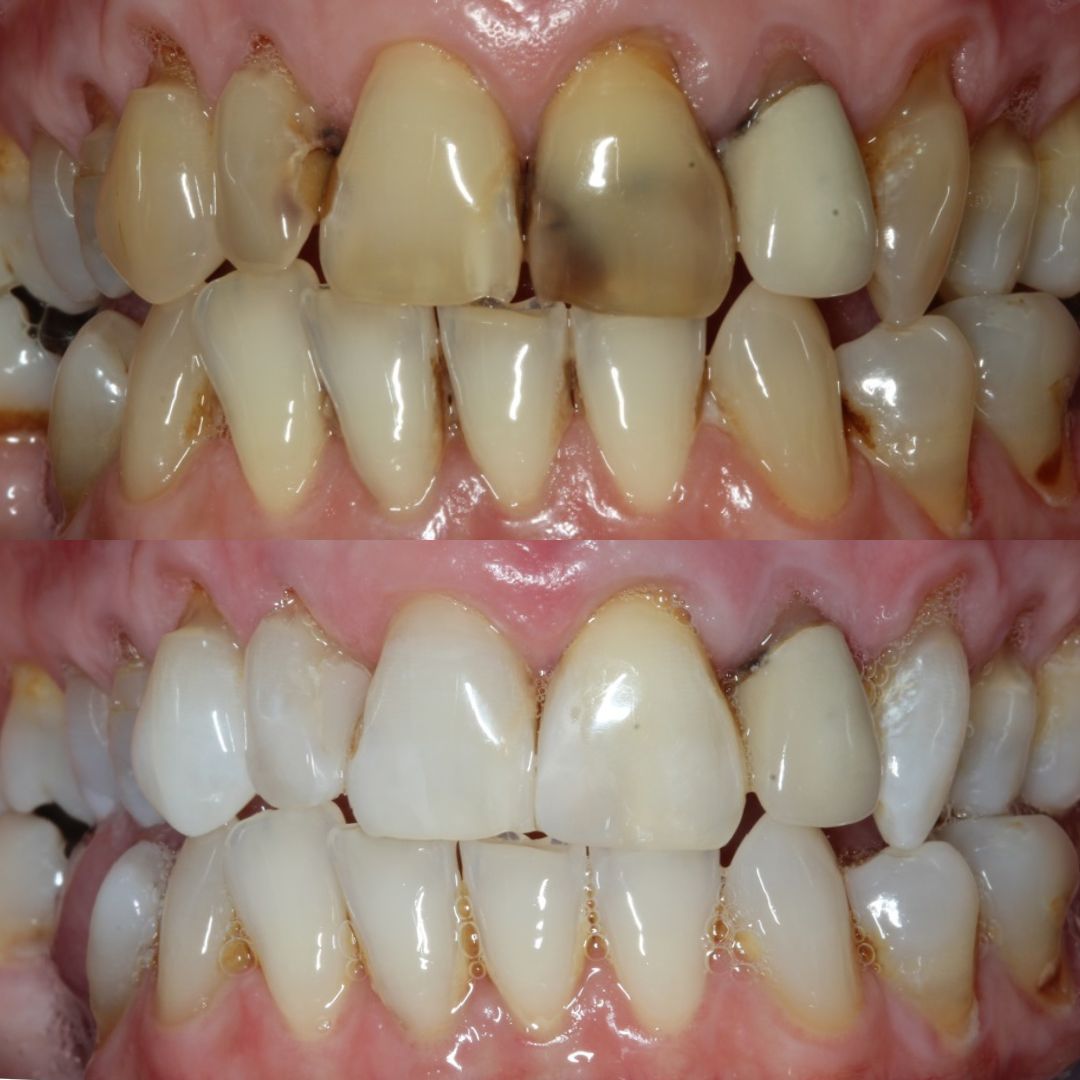 Ravenhill Dental Care Welcome To Raven Hill Dental Practice Ravenhill Dental Care B&As