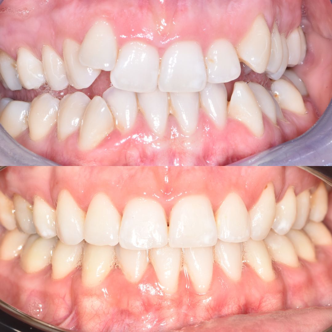 Correction of sever upper and lower crowding with fixed clear aligners